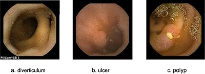 Clinical assessment of small bowel capsule endoscopy in pediatric patients